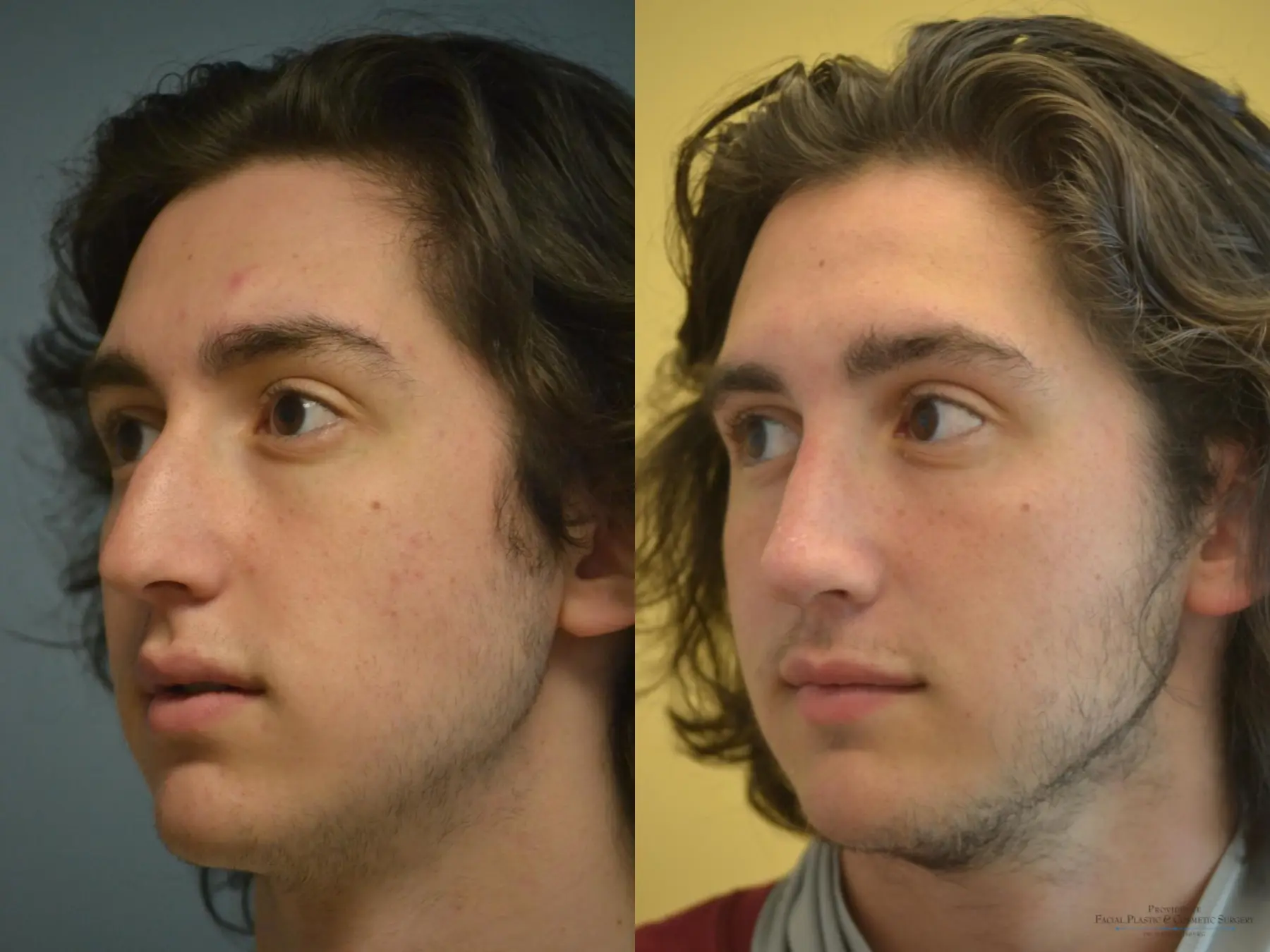 Rhinoplasty: Patient 15 - Before and After 2