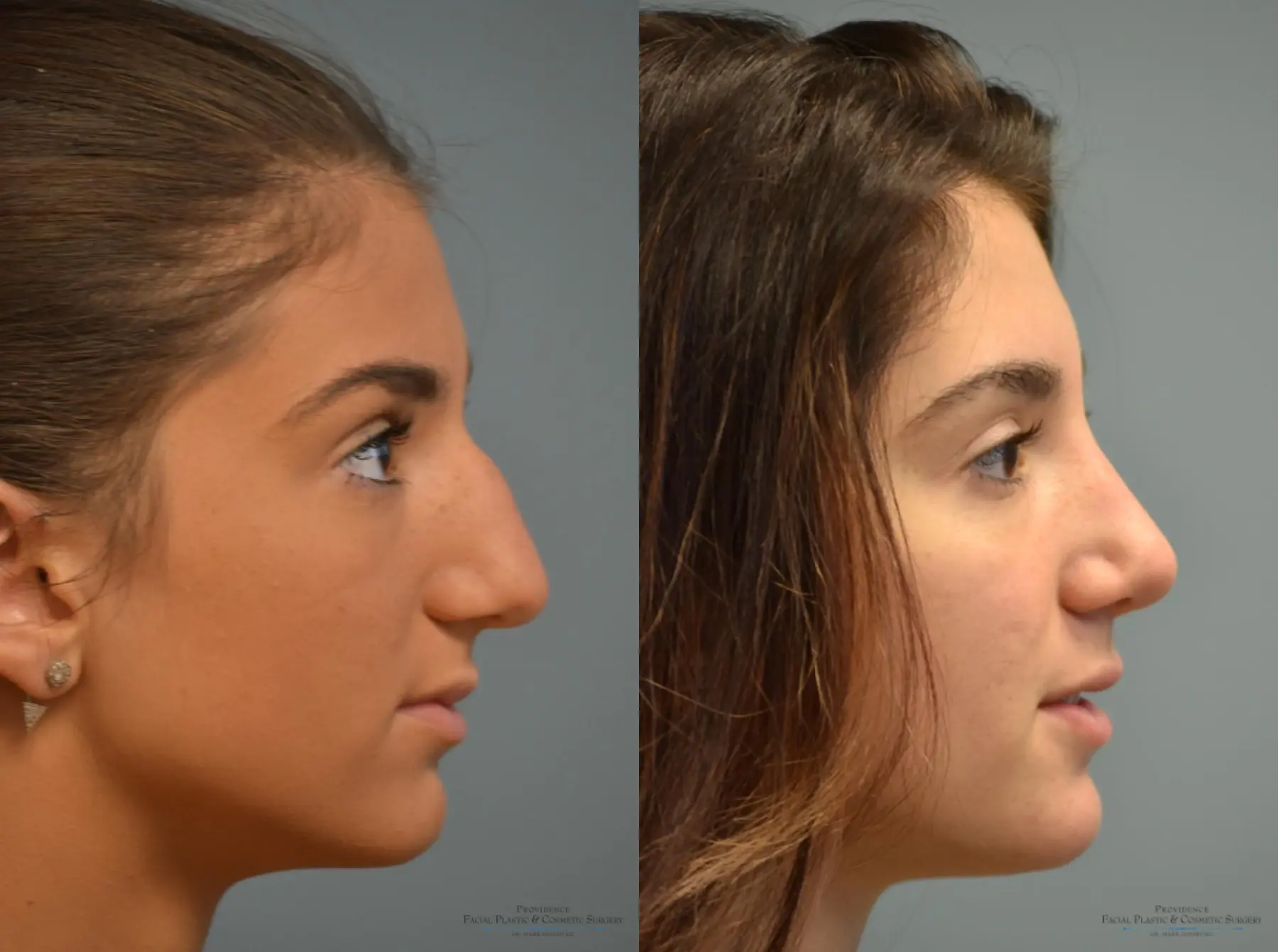 Rhinoplasty: Patient 18 - Before and After 3