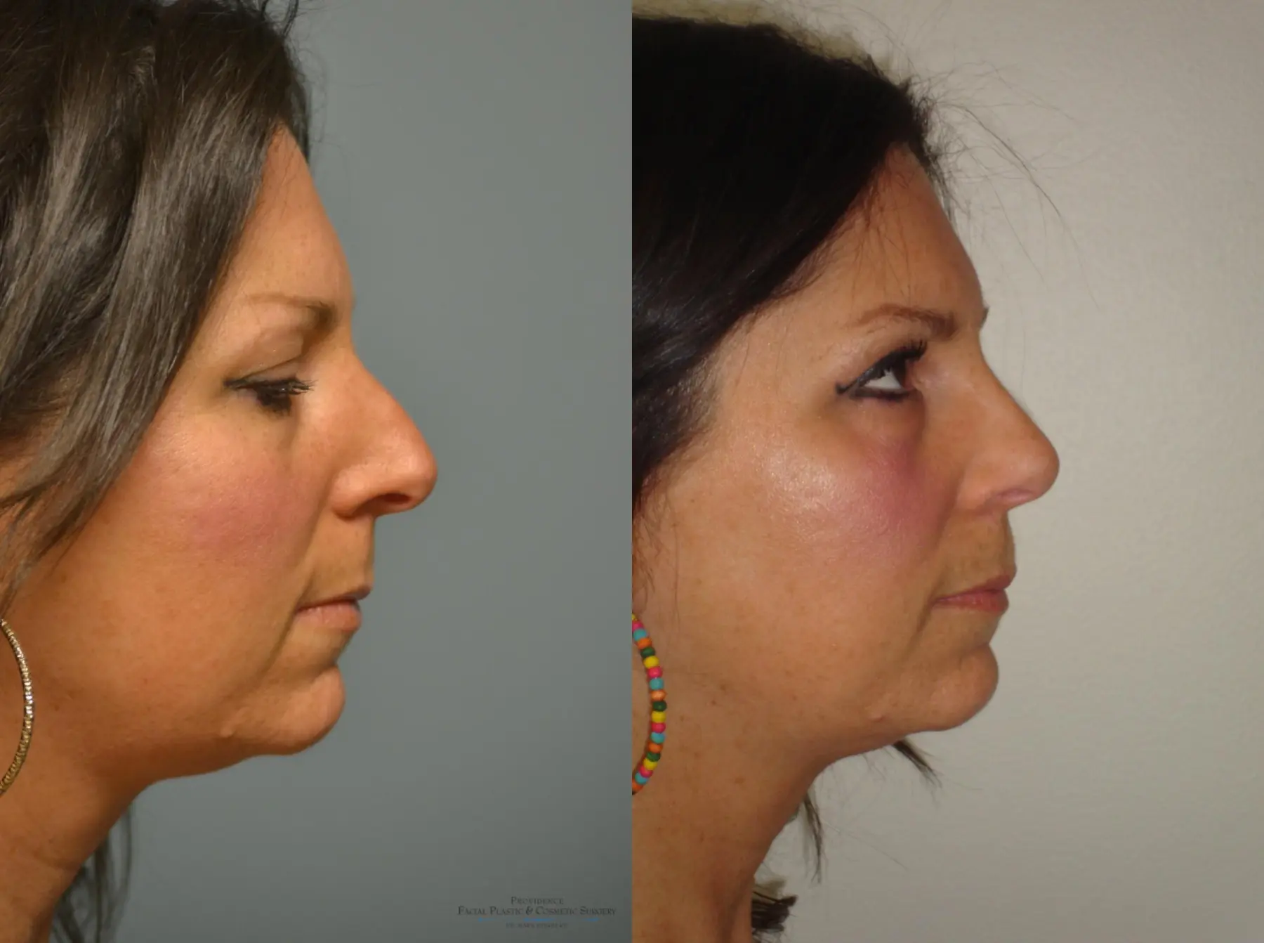 Rhinoplasty: Patient 16 - Before and After 4