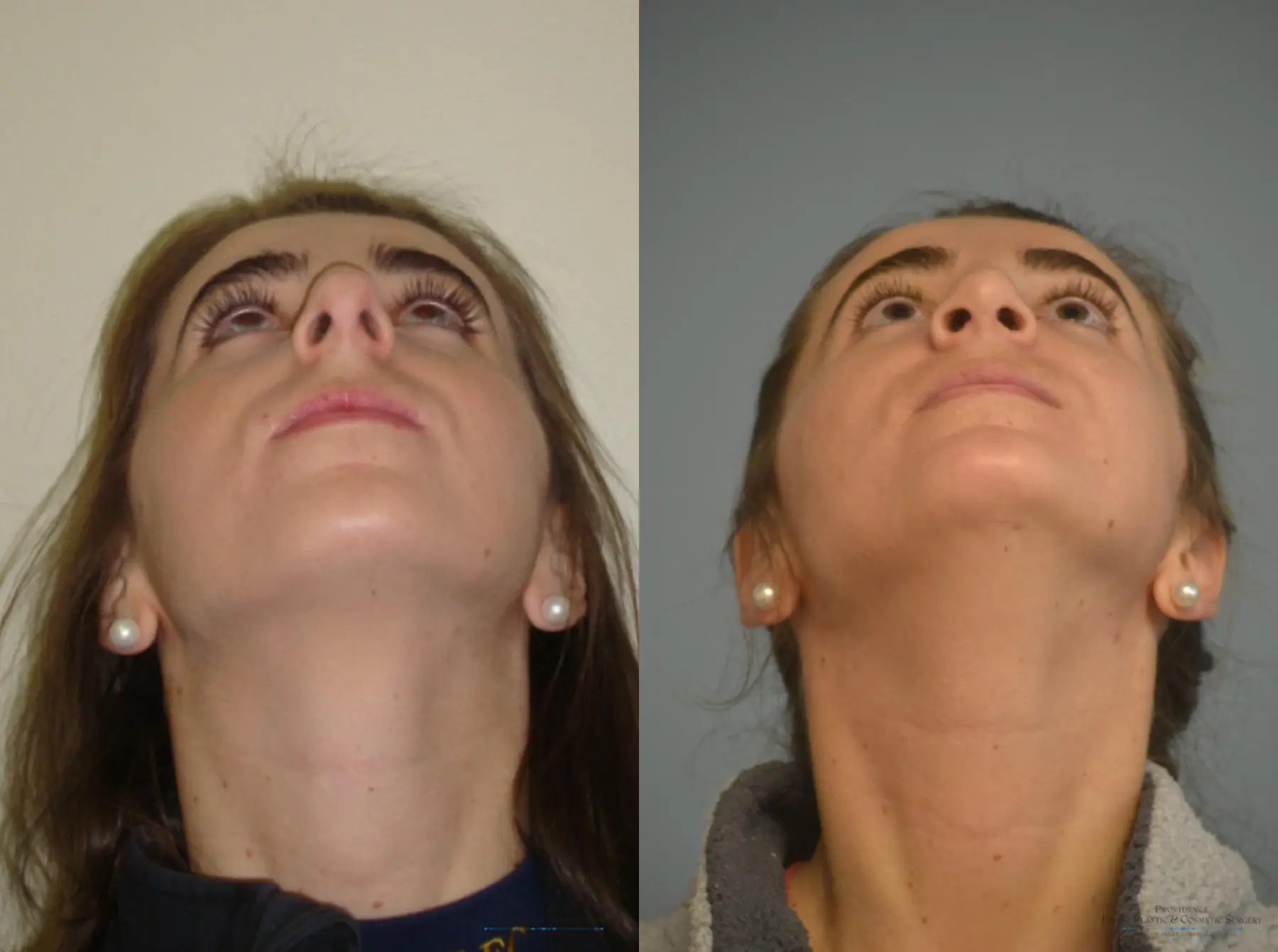 Rhinoplasty: Patient 23 - Before and After 5