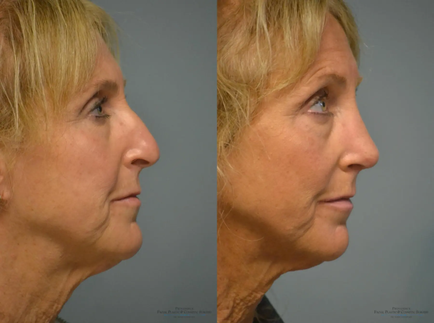 Rhinoplasty: Patient 14 - Before and After 3