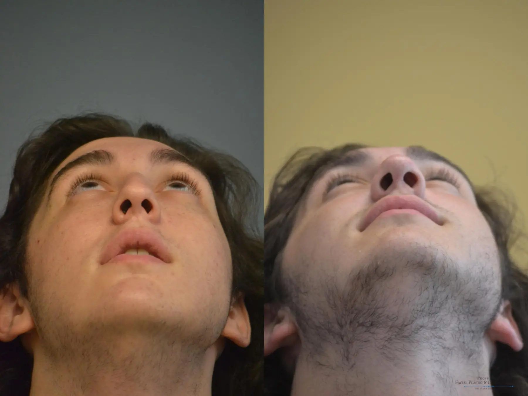 Rhinoplasty: Patient 15 - Before and After 5