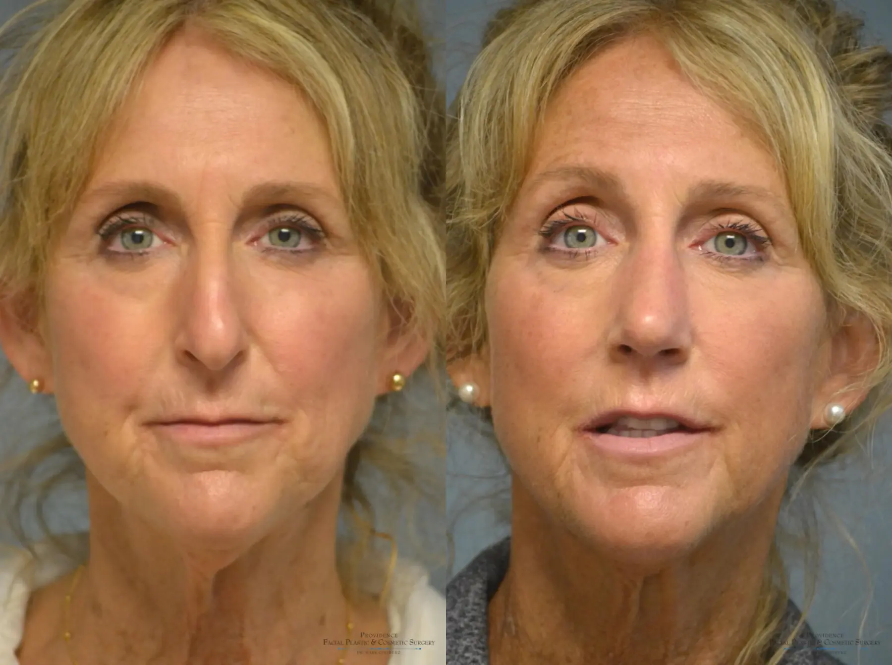 Rhinoplasty: Patient 14 - Before and After 1