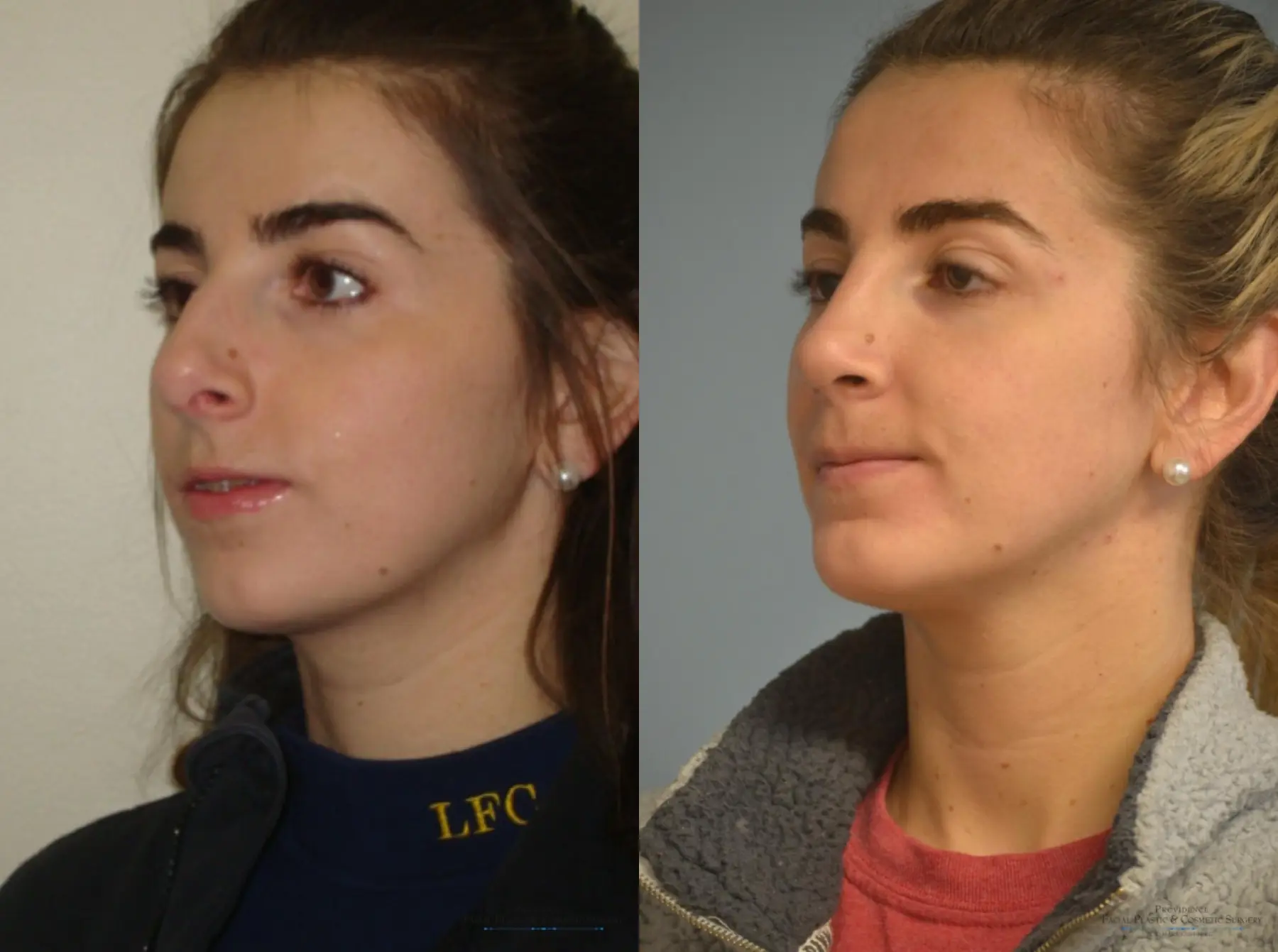 Rhinoplasty: Patient 23 - Before and After 3