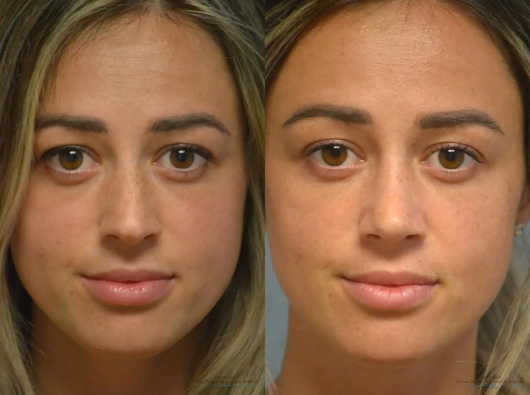 Rhinoplasty: Patient 12 - Before and After 1