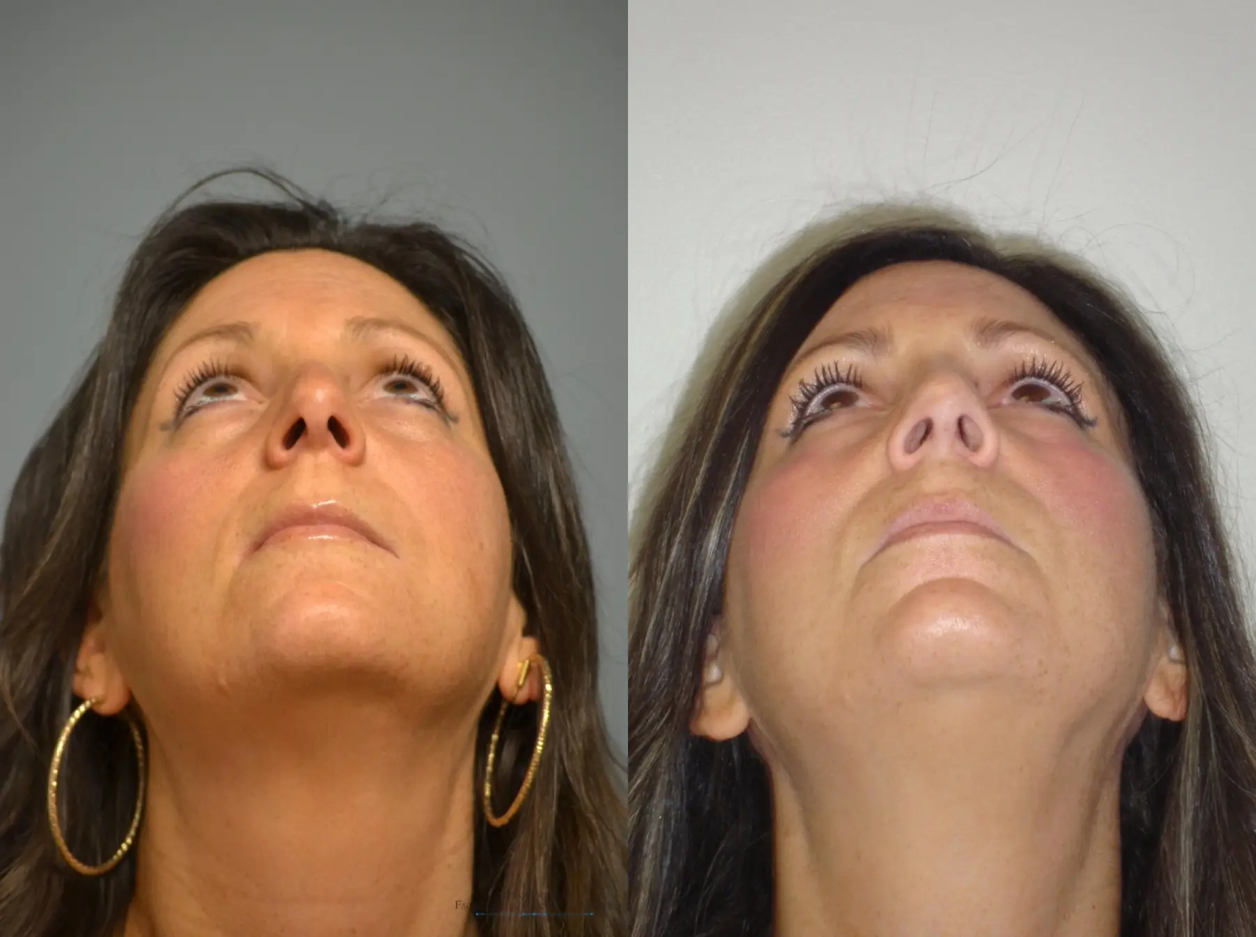 Rhinoplasty: Patient 16 - Before and After 5