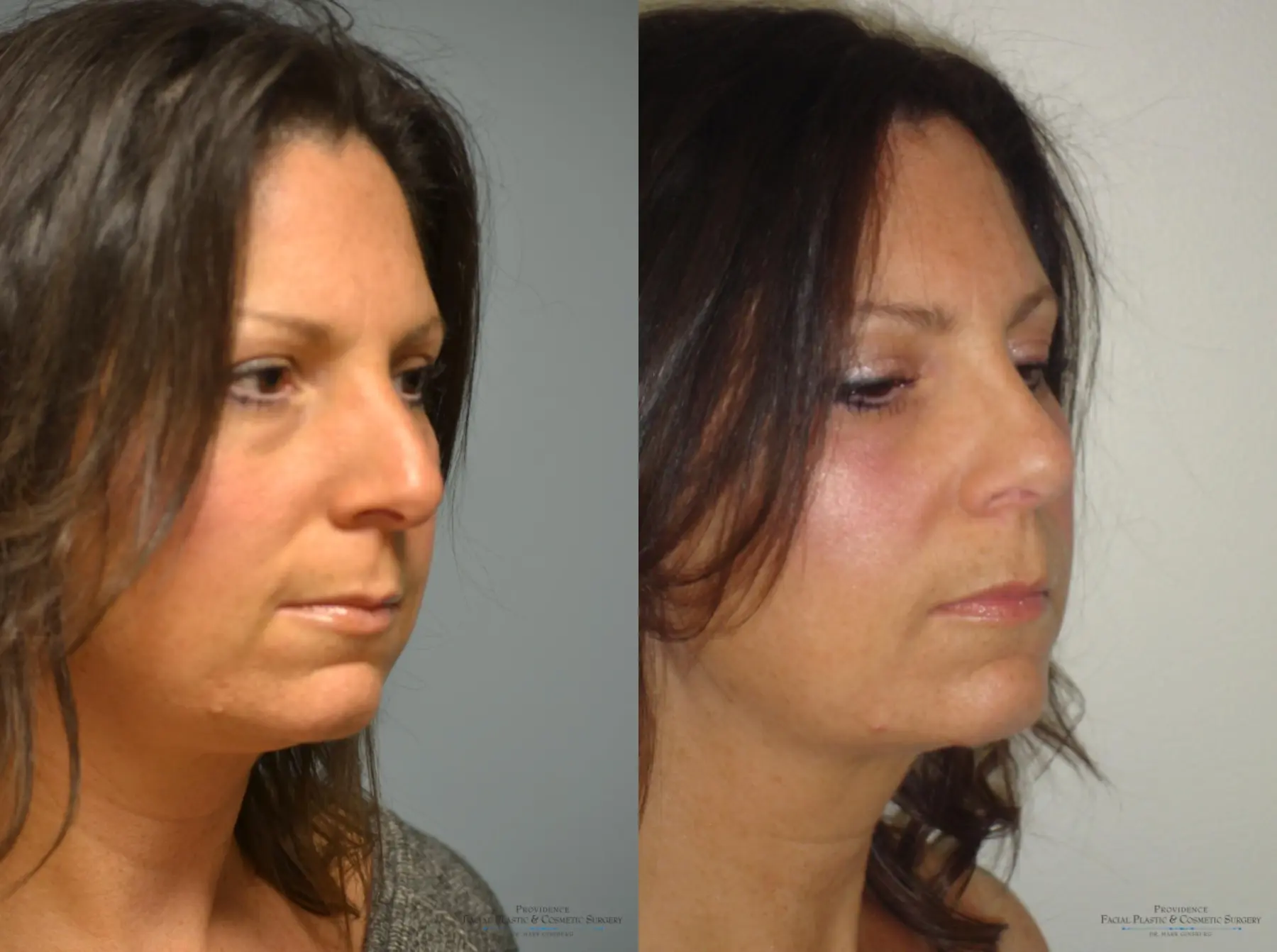 Rhinoplasty: Patient 16 - Before and After 3