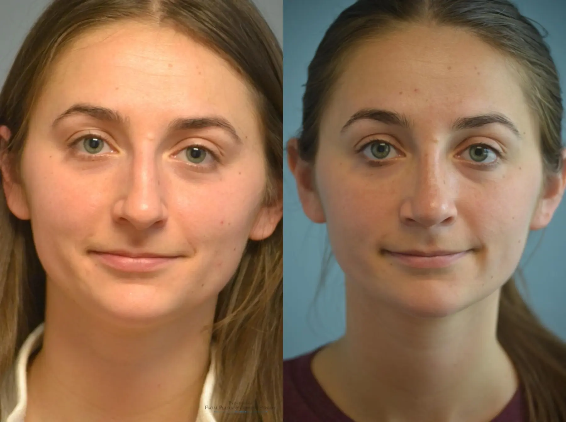 Rhinoplasty: Patient 21 - Before and After 1