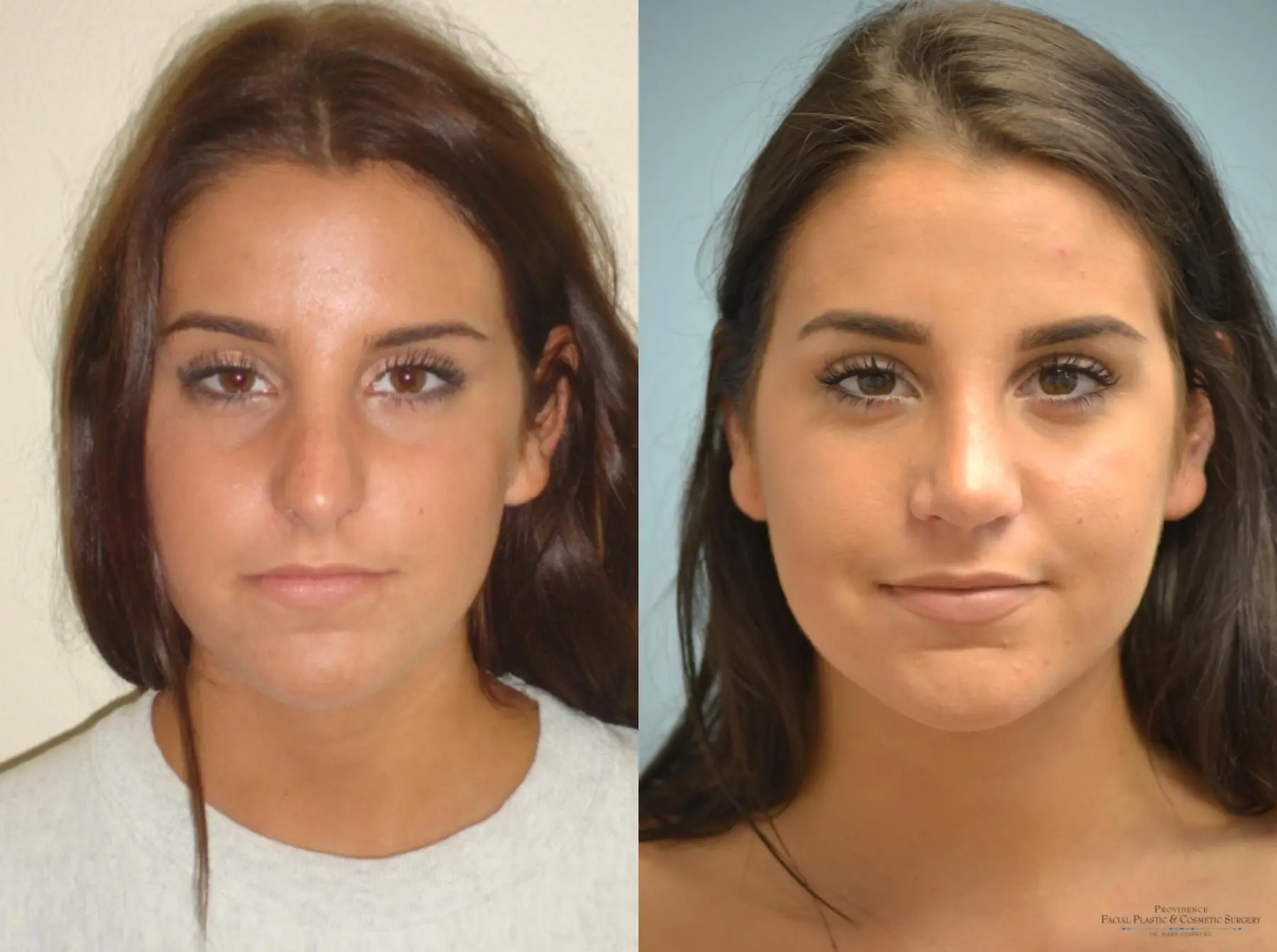 Rhinoplasty: Patient 17 - Before and After 1