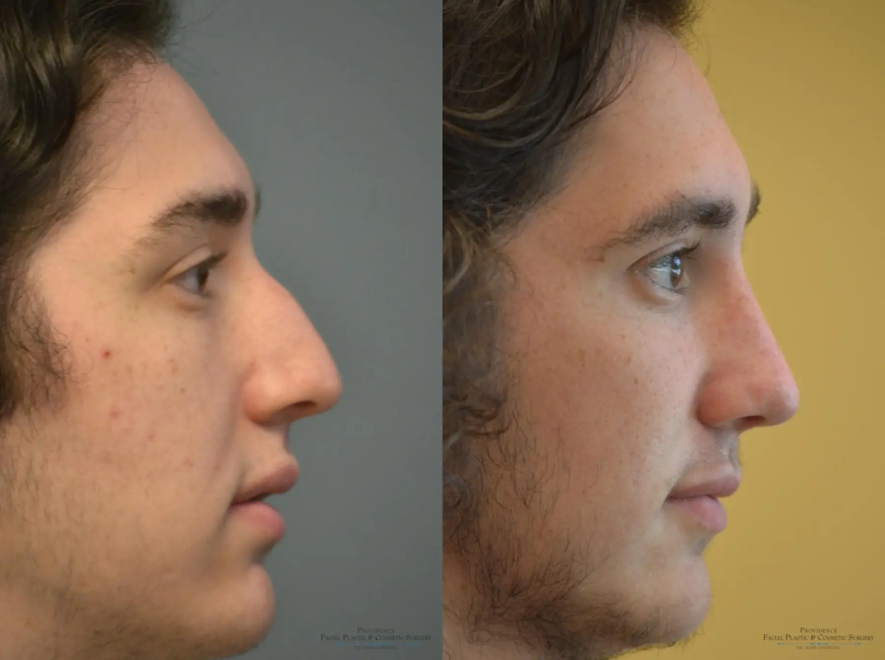 Rhinoplasty: Patient 15 - Before and After 4