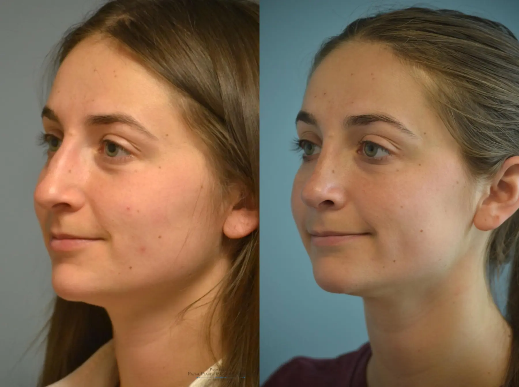 Rhinoplasty: Patient 21 - Before and After 2