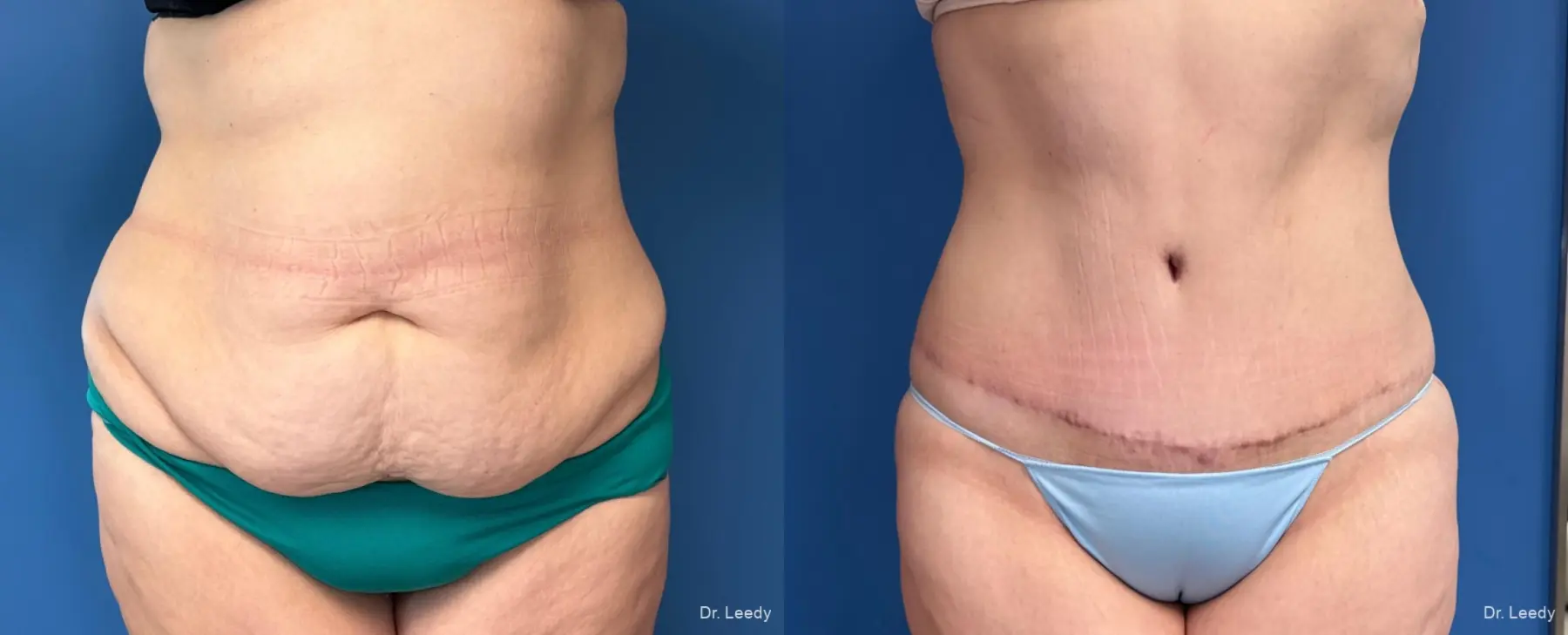 Abdominoplasty: Patient 28 - Before and After  