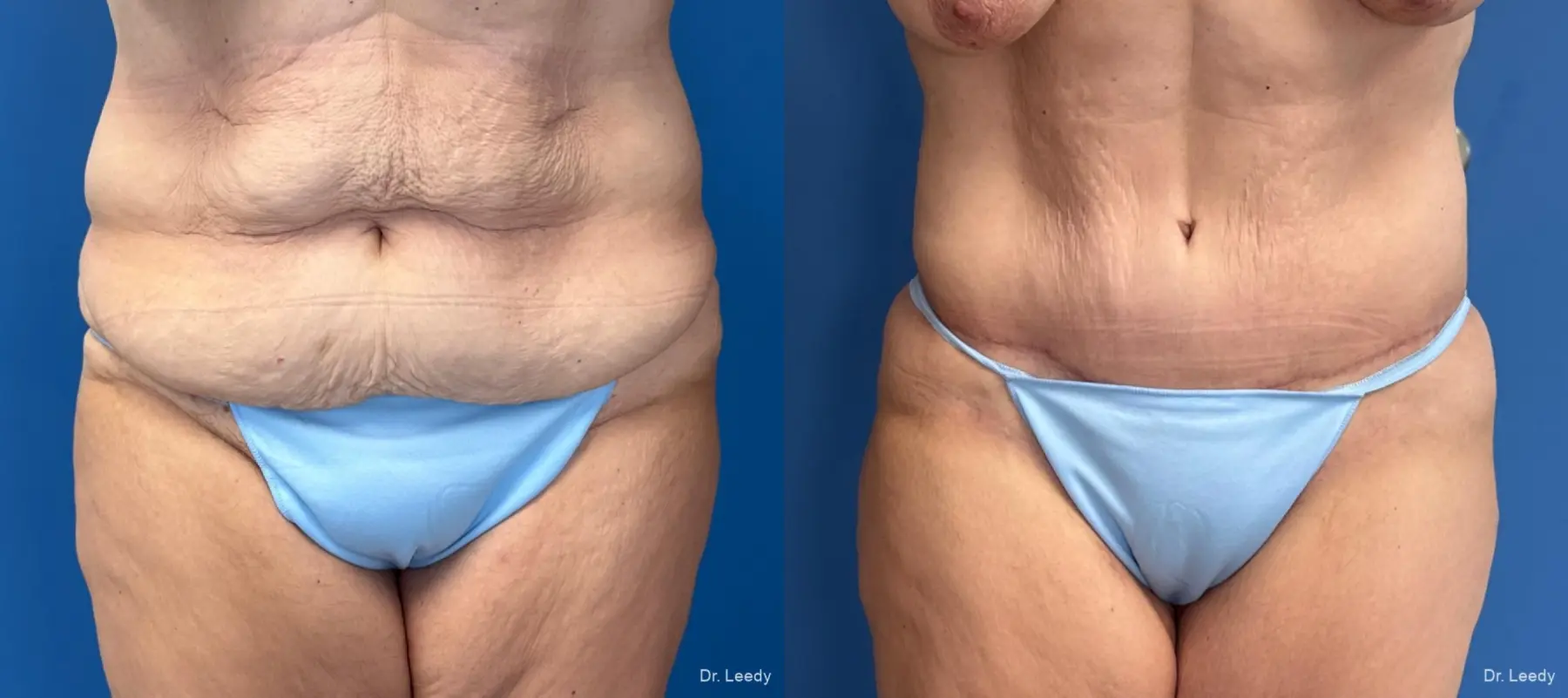 Abdominoplasty With BBL: Patient 10 - Before and After  