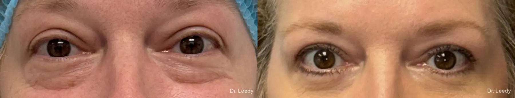 Blepharoplasty: Patient 3 - Before and After  