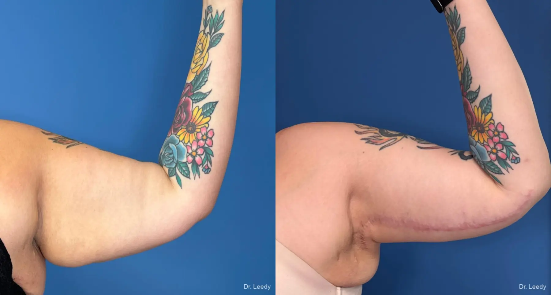 Brachioplasty: Patient 8 - Before and After  