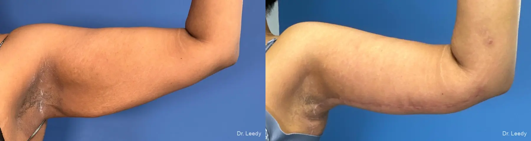 Brachioplasty: Patient 10 - Before and After  