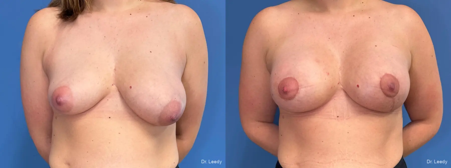 Breast Asymmetry: Patient 2 - Before and After  