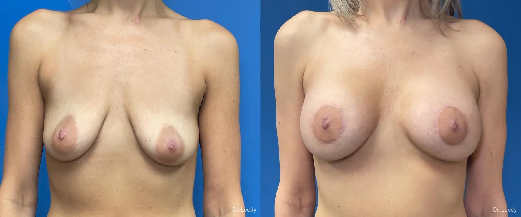 Breast Augmentation With Lift: Patient 7 - Before and After  