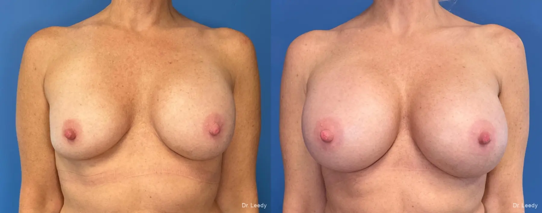 Breast Implant Exchange: Patient 7 - Before and After  