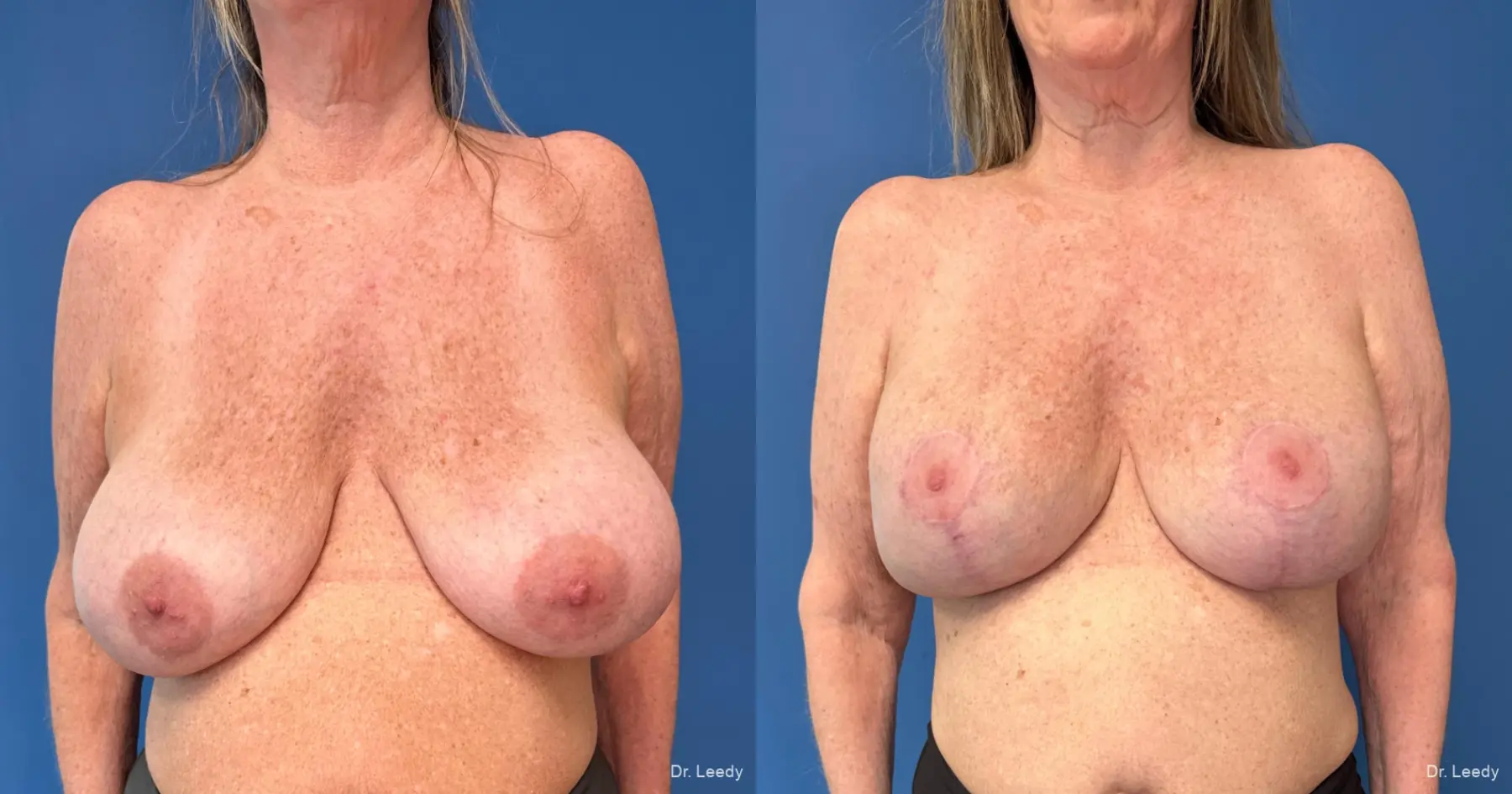 Breast Implant Exchange: Patient 7 - Before and After  