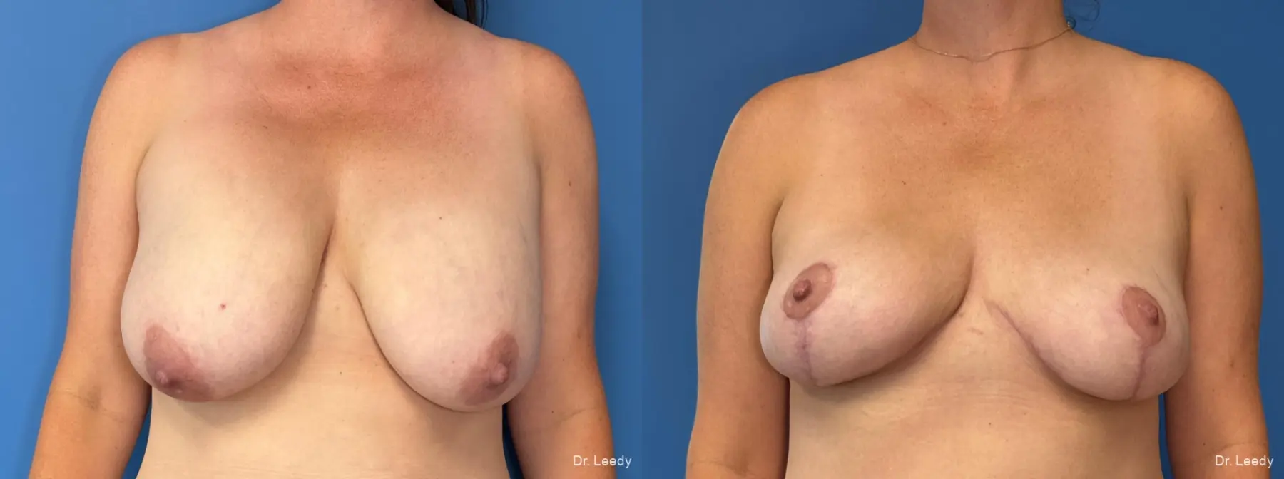 Breast Implant Removal With Lift: Patient 3 - Before and After  