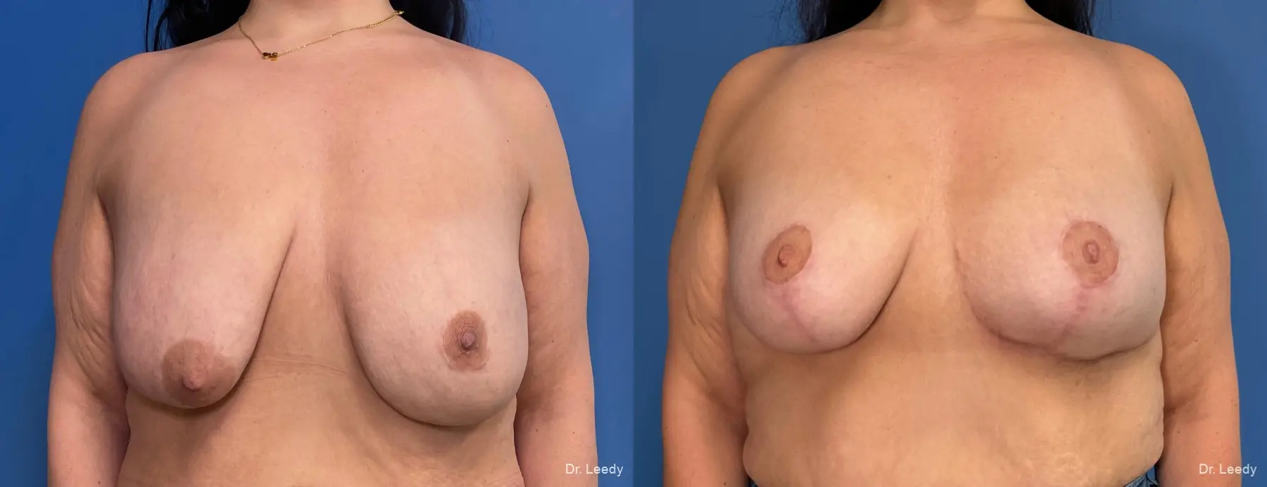 Breast Revision: Patient 4 - Before and After  