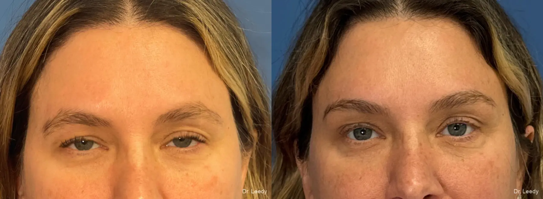 Brow Lift: Patient 7 - Before and After  