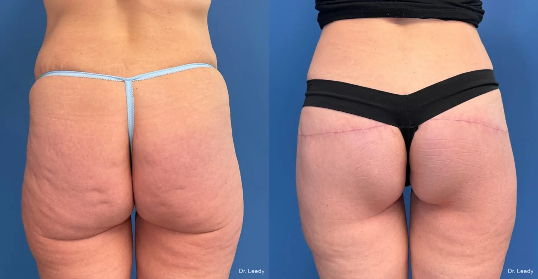 Butt Augmentation: Patient 1 - Before and After  