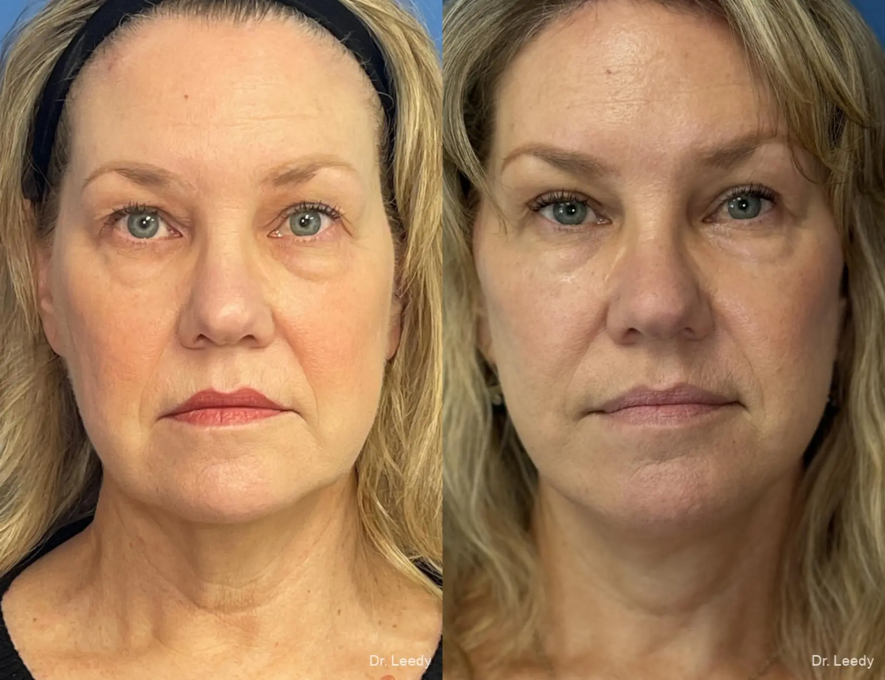 Facial Rejuvenation: Patient 2 - Before and After  
