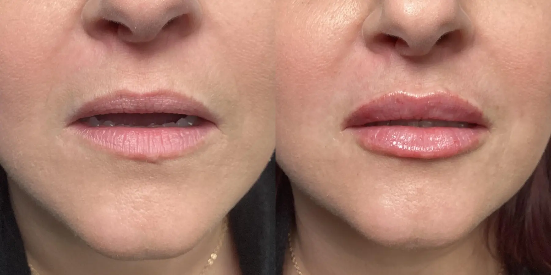 Fillers: Patient 10 - Before and After  