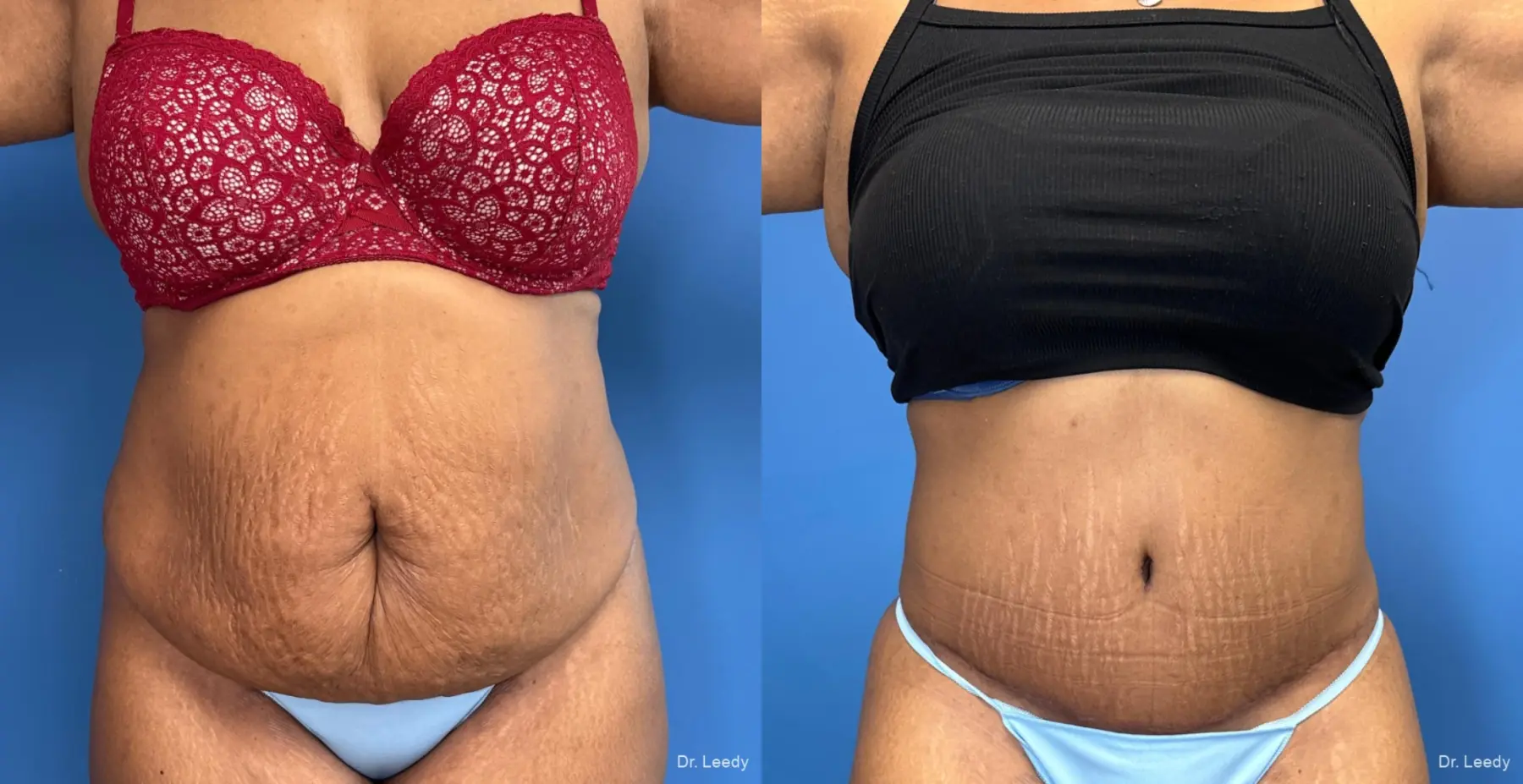 Lipoabdominoplasty: Patient 2 - Before and After  