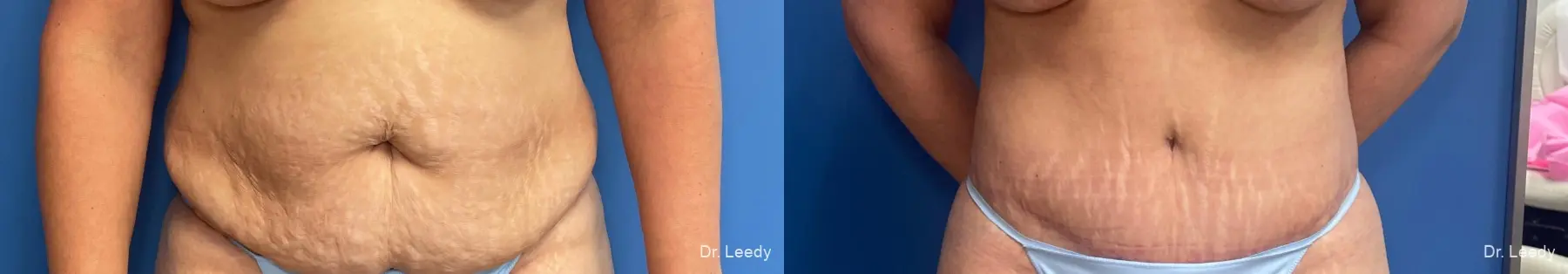 Lipoabdominoplasty: Patient 1 - Before and After  
