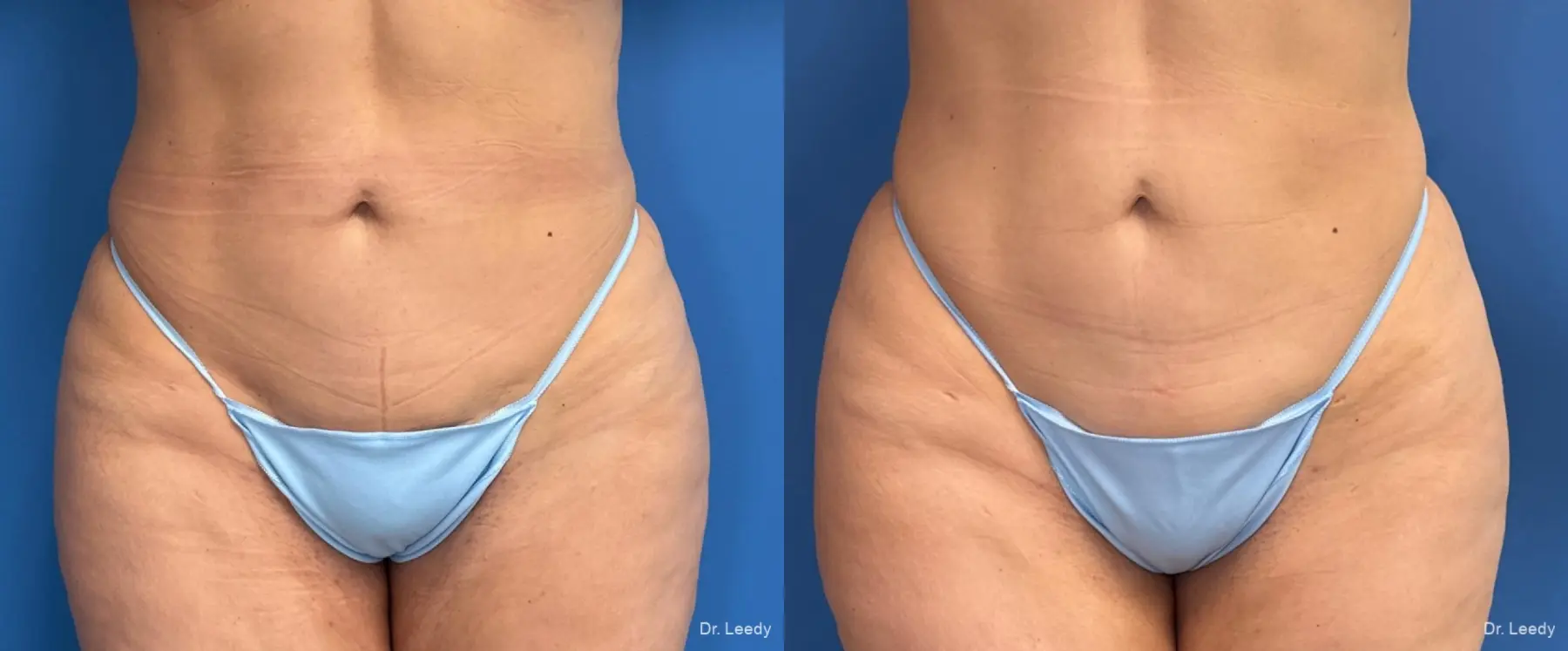 Liposuction: Patient 9 - Before and After  