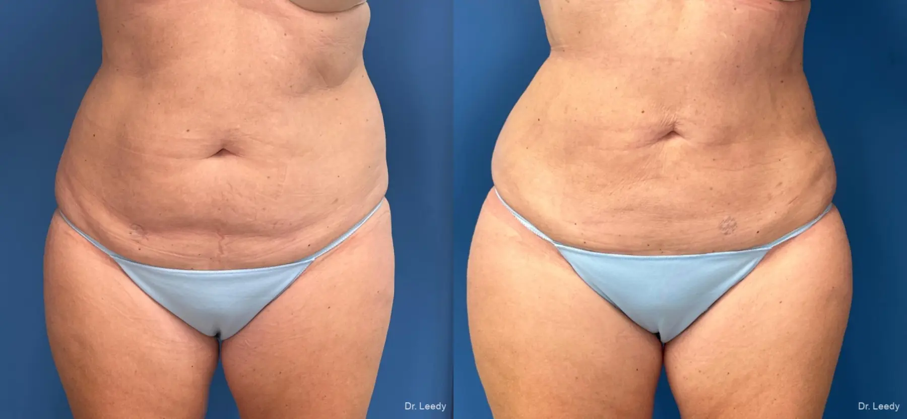 Liposuction: Patient 7 - Before and After  