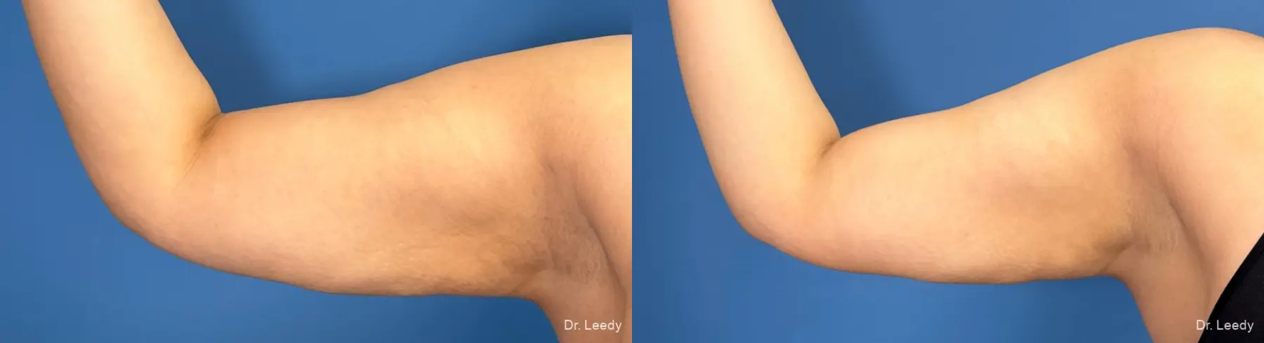 Liposuction: Patient 10 - Before and After  