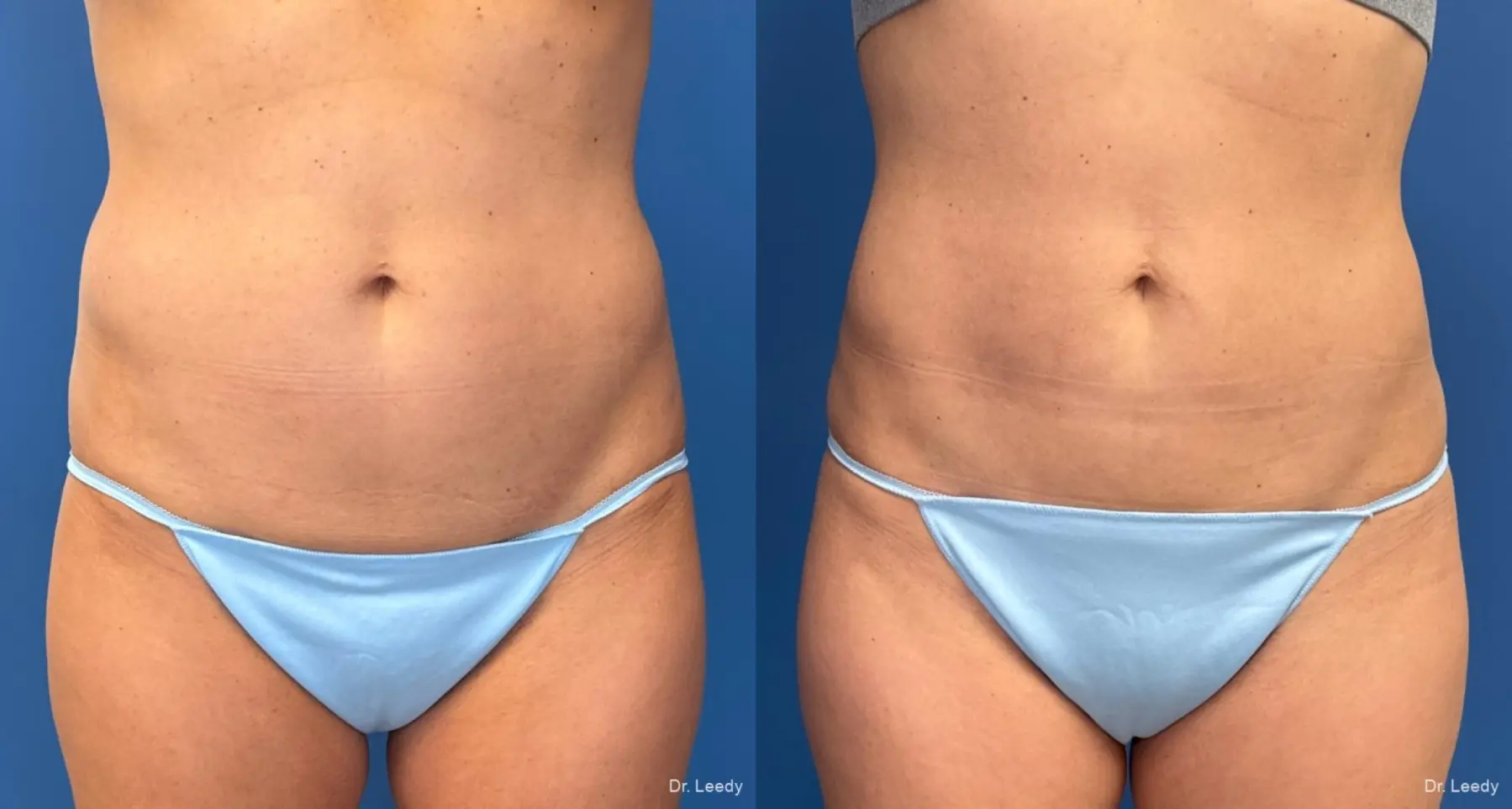 Liposuction: Patient 8 - Before and After  