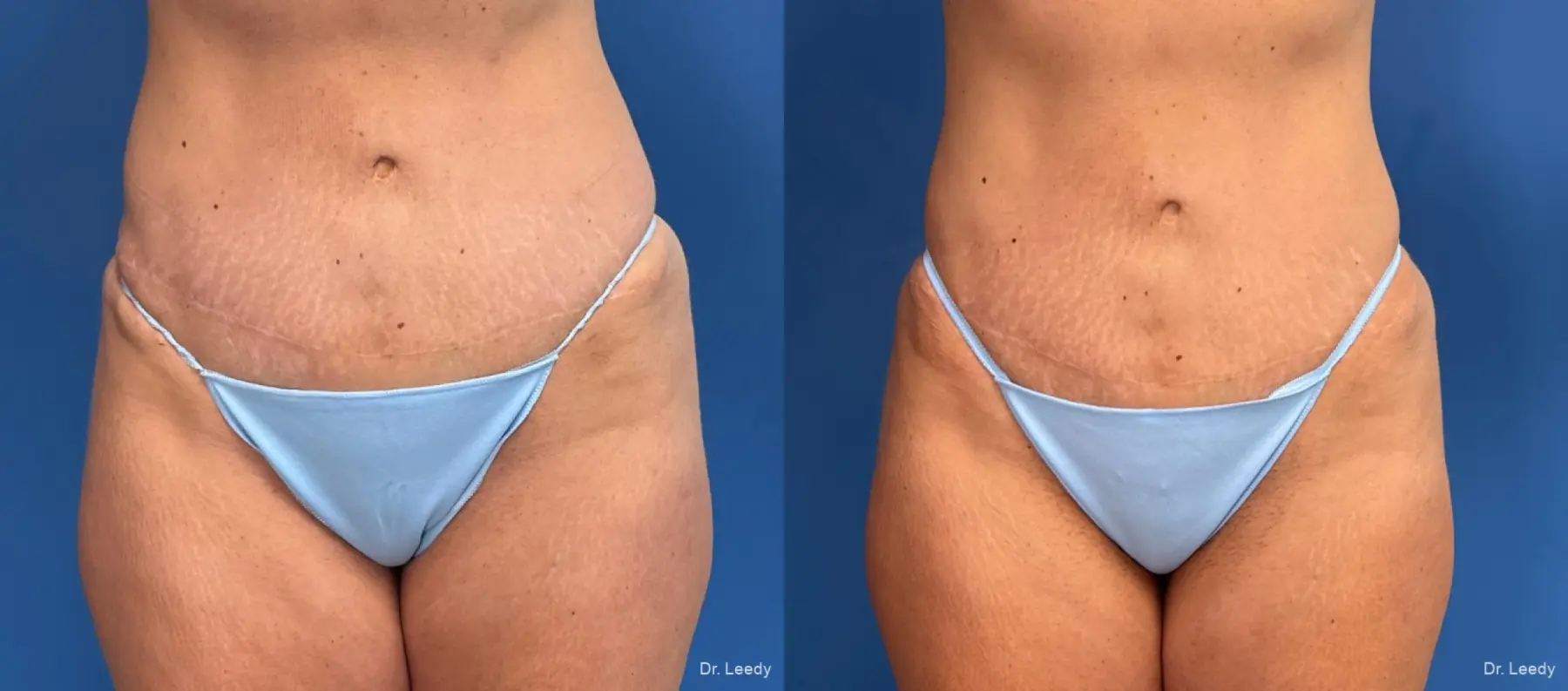 Liposuction: Patient 7 - Before and After  