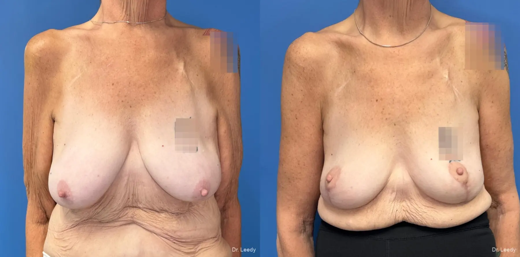 Mastopexy: Patient 6 - Before and After  