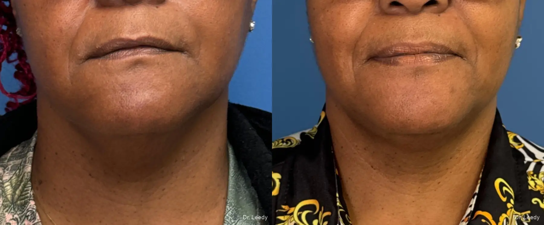 SmartLipo® - Chin: Patient 8 - Before and After  