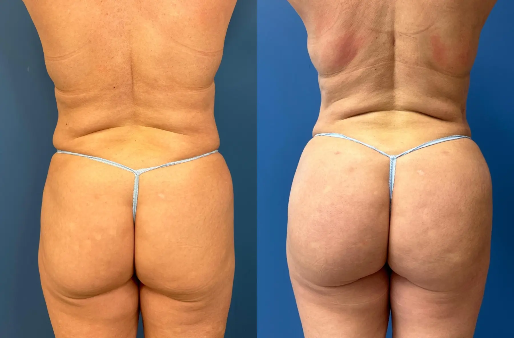 SmartLipo®: Patient 2 - Before and After  