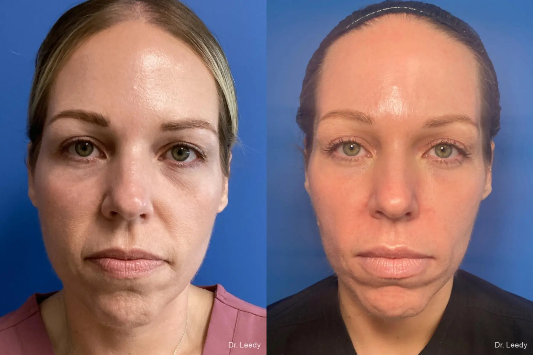 Thermage: Patient 2 - Before and After  