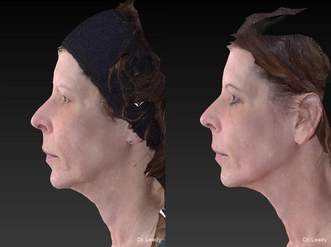 Thermage: Patient 1 - Before and After  