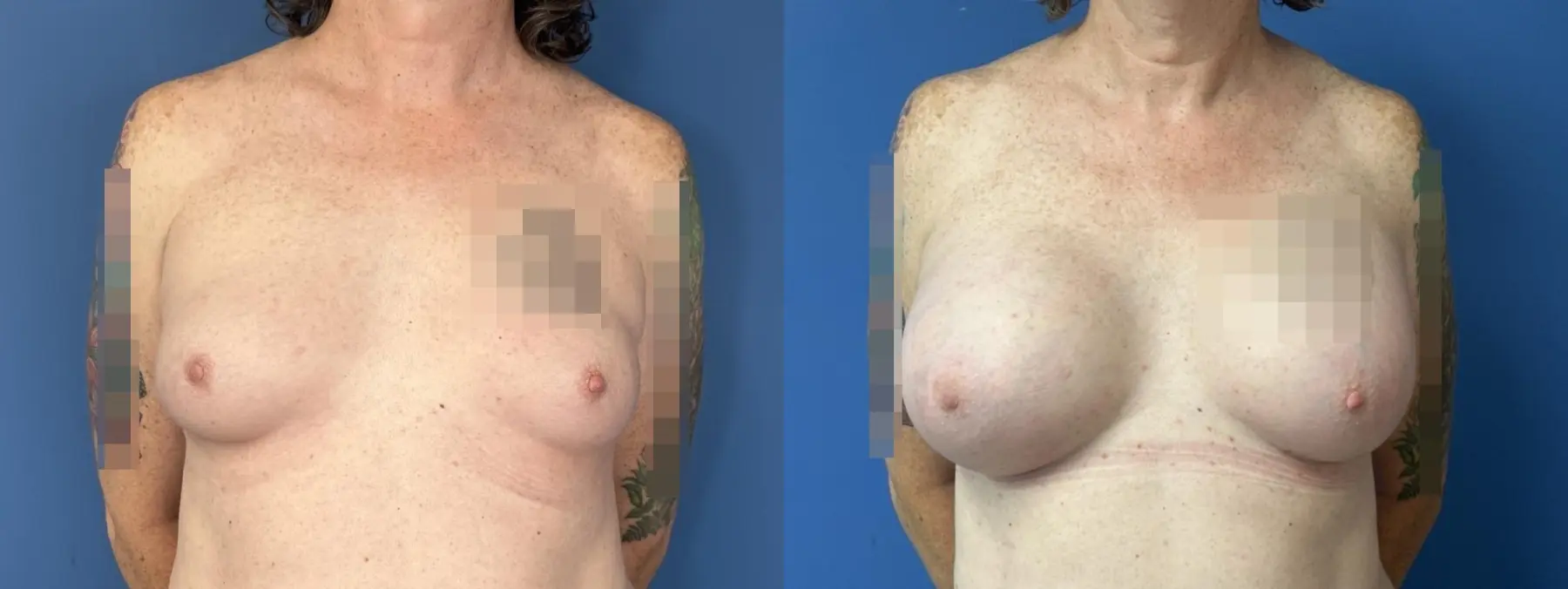 Top surgery breast augmentation - Before and After  