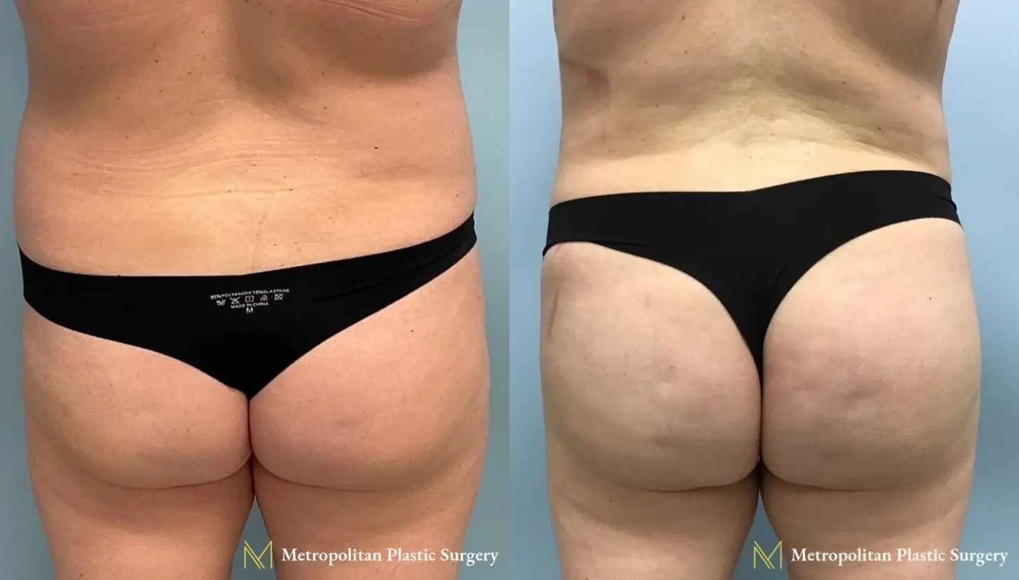 Brazilian Butt Lift: Patient 1 - Before and After  