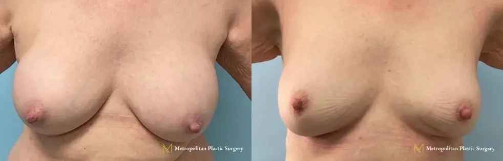 Before and after breast implant removal by Julia Spears MD - Before and After