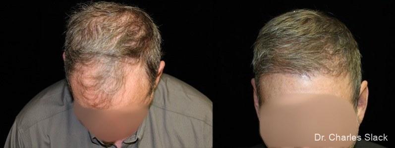 Hair Transplantation: Patient 4 - Before and After  