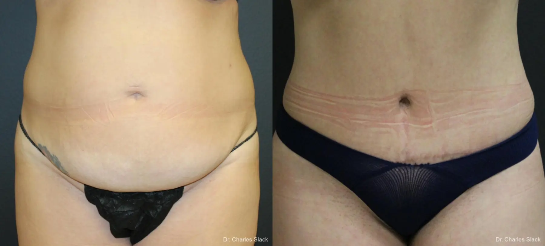 360 Body Contour: Patient 3 - Before and After  