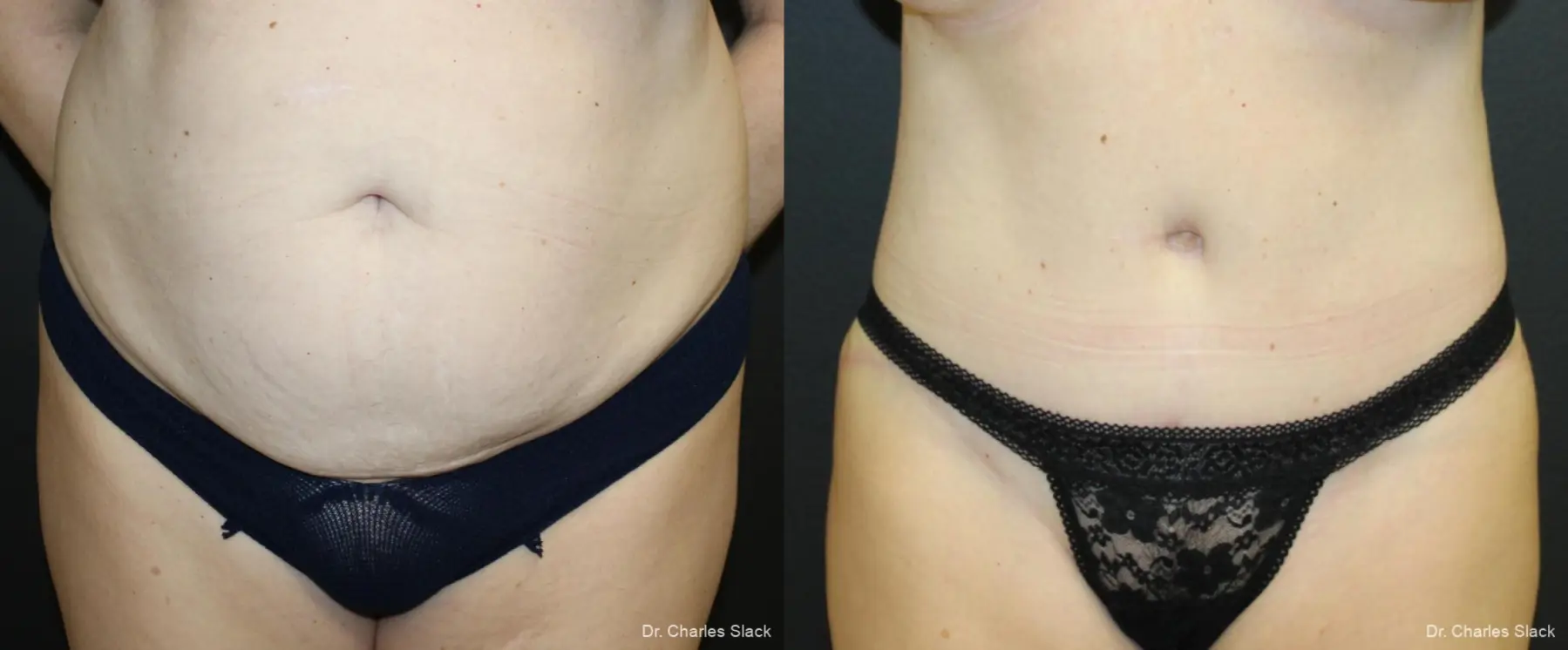 360 Body Contour: Patient 1 - Before and After  