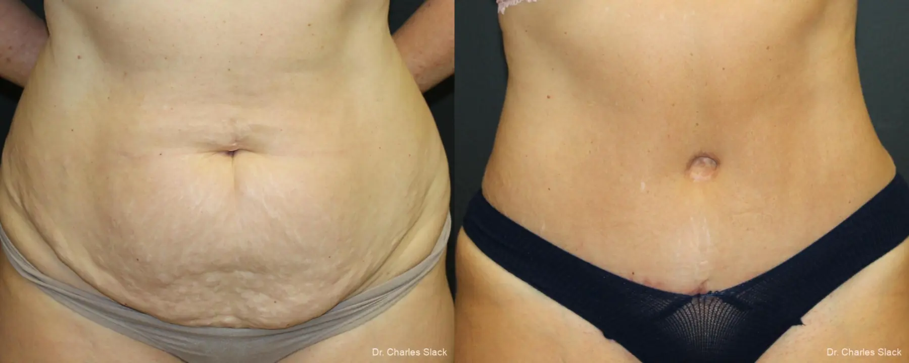 360 Body Contour: Patient 2 - Before and After  