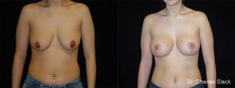 Breast Augmentation With Lift: Patient 10 - Before and After  